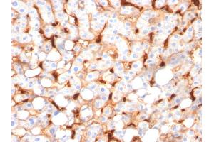 Formalin-fixed, paraffin-embedded human Hepatocellular Carcinoma stained with C1QB Mouse Monoclonal Antibody (C1QB/2966). (C1QB Antikörper  (AA 41-188))