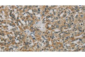 Immunohistochemistry of paraffin-embedded Human esophagus cancer using E2F6 Polyclonal Antibody at dilution of 1:60 (E2F6 Antikörper)