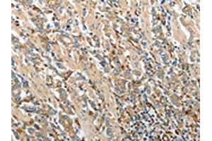 The image on the left is immunohistochemistry of paraffin-embedded Human gastric cancer tissue using ABIN7130695(PRCP Antibody) at dilution 1/20, on the right is treated with fusion protein. (PRCP Antikörper)