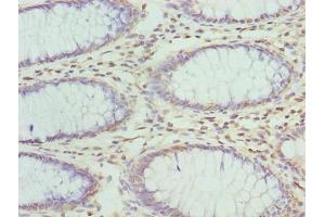 Immunohistochemistry of paraffin-embedded human colon cancer using ABIN7176343 at dilution of 1:100 (ZNF546 Antikörper  (AA 101-400))