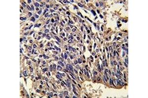 IHC analysis of FFPE human lung carcinoma stained with IL-1 antibody (IL1A Antikörper  (AA 177-206))