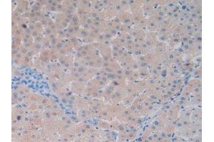 IHC-P analysis of Human Liver Cancer Tissue, with DAB staining. (Vitamin D-Binding Protein Antikörper  (AA 209-401))