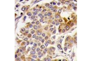 Formalin-fixed and paraffin-embedded human breast carcinoma tissue reacted with PRKAA1, which was peroxidase-conjugated to the secondary antibody, followed by DAB staining. (PRKAA1 Antikörper  (Ser487))
