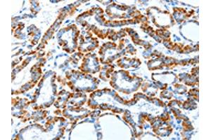 The image on the left is immunohistochemistry of paraffin-embedded Human thyroid cancer tissue using (TLR2 Antibody) at dilution 1/30, on the right is treated with fusion protein. (TLR2 Antikörper)