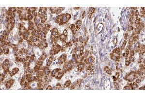 ABIN6278182 at 1/100 staining Human liver cancer tissue by IHC-P. (P2RX7 Antikörper  (C-Term))