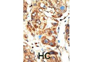 Formalin-fixed and paraffin-embedded human hepatocellular carcinoma tissue reacted with MAGI1 polyclonal antibody  , which was peroxidase-conjugated to the secondary antibody, followed by AEC staining. (MAGI1 Antikörper  (C-Term))