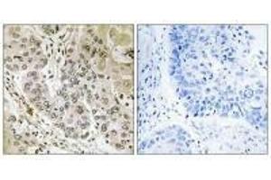 Immunohistochemistry analysis of paraffin-embedded human lung carcinoma tissue, using STK36 antibody. (STK36 Antikörper)