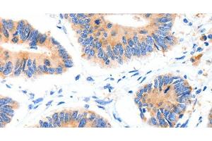 Immunohistochemistry of paraffin-embedded Human colon cancer tissue using GLUT-4 Polyclonal Antibody at dilution 1:70 (GLUT4 Antikörper)