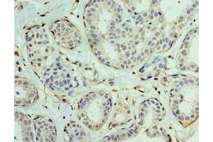Immunohistochemistry of paraffin-embedded human breast cancer using ABIN7152130 at dilution of 1:100 (EIF1AX Antikörper  (AA 10-144))