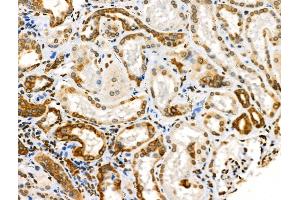 Phospho-Cytokeratin 18 (Ser53) Antibody at 1/100 staining Human kidney cancer and adjacent normal tissues by IHC-P. (Cytokeratin 18 Antikörper  (pSer53))