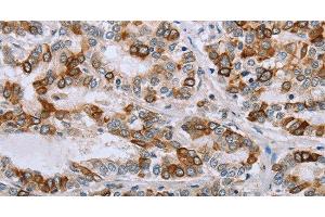 Immunohistochemistry of paraffin-embedded Human liver cancer tissue using NMT1 Polyclonal Antibody at dilution 1:45 (NMT1 Antikörper)