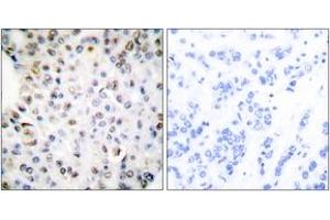 Immunohistochemistry analysis of paraffin-embedded human breast carcinoma tissue, using Retinoid X Receptor gamma Antibody. (Retinoid X Receptor gamma Antikörper  (AA 171-220))