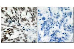 Immunohistochemical analysis of paraffin- embedded human breast carcinoma tissue using Rb (Ab-780) antibody (E021110). (Retinoblastoma 1 Antikörper)