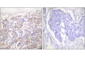 Immunohistochemistry analysis of paraffin-embedded human breast carcinoma tissue, using TNF Receptor I Antibody. (TNFRSF1A Antikörper  (AA 381-430))