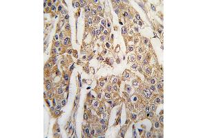 Formalin-fixed and paraffin-embedded human breast carcinoma tissue reacted with PKM2 antibody (C-term ) (ABIN391256 and ABIN2841316) , which was peroxidase-conjugated to the secondary antibody, followed by DAB staining. (PKM2 Antikörper  (C-Term))