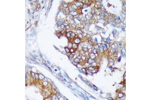 Immunohistochemistry of paraffin-embedded Human colon carcinoma using R Rabbit pAb (ABIN7269785) at dilution of 1:100 (40x lens). (RABGAP1 Antikörper  (AA 830-1069))