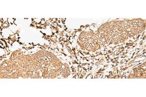 Immunohistochemistry of paraffin-embedded Human esophagus cancer tissue using FER Polyclonal Antibody at dilution of 1:90(x200) (FER Antikörper)