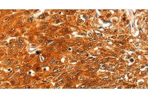 Immunohistochemistry of paraffin-embedded Human esophagus cancer using SERPINB5 Polyclonal Antibody at dilution of 1:60