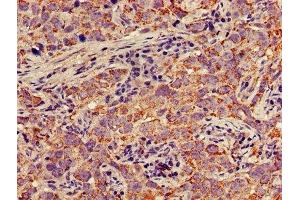 IHC image of ABIN7150697 diluted at 1:300 and staining in paraffin-embedded human pancreatic cancer performed on a Leica BondTM system. (MEK1 Antikörper  (AA 2-79))