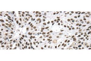 Immunohistochemistry of paraffin-embedded Human breast cancer using DDX39B Polyclonal Antibody at dilution of 1/40 (DDX39B Antikörper)
