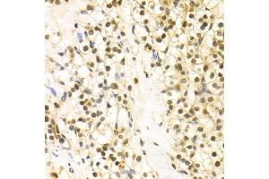 Immunohistochemistry of paraffin-embedded human kidney cancer using BAG1 Antibody (ABIN5970457) at dilution of 1/100 (40x lens). (BAG1 Antikörper)