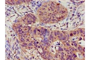 Immunohistochemistry of paraffin-embedded human colon cancer using ABIN7169527 at dilution of 1:100 (TRPC1 Antikörper  (AA 39-207))