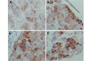 Immunohistochemical analysis of paraffin-embedded human hepatocarcinoma (A), breast carcinoma (B) and lung cancer tissue (C), showing cytoplasmic localization with DAB staining.