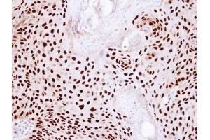 IHC-P Image Immunohistochemical analysis of paraffin-embedded Cal27 Xenograft, using Ku80 (XRCC5), antibody at 1:100 dilution. (X-Ray Repair Cross Complementing 5 Antikörper)