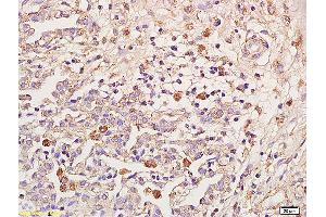 Formalin-fixed and paraffin embedded human pulmonitis labeled with Anti-IL-18R Beta/IL1R7/CD218b Polyclonal Antibody, Unconjugated (ABIN748058) at 1:200 followed by conjugation to the secondary antibody and DAB staining (IL18RAP Antikörper  (AA 15-120))