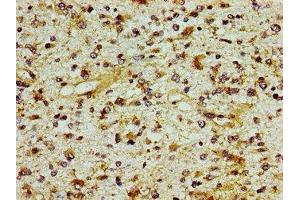 Immunohistochemistry of paraffin-embedded human glioma using ABIN7156245 at dilution of 1:100 (ING1 Antikörper  (AA 260-353))