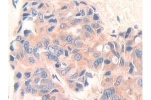Detection of DEP1 in Human Breast cancer Tissue using Polyclonal Antibody to Density Enhanced Phosphatase 1 (DEP1) (PTPRJ Antikörper  (AA 1061-1293))