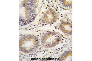 Formalin-fixed and paraffin-embedded human colon carcinomareacted with LEFTY1 polyclonal antibody , which was peroxidase-conjugated to the secondary antibody, followed by AEC staining.