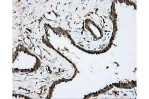 Immunohistochemical staining of paraffin-embedded Carcinoma of prostate tissue using anti-BTK mouse monoclonal antibody. (BTK Antikörper)