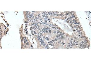Immunohistochemistry of paraffin-embedded Human colorectal cancer tissue using UFM1 Polyclonal Antibody at dilution of 1:45(x200) (UFM1 Antikörper)