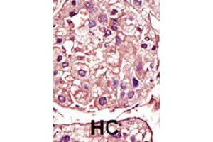Formalin-fixed and paraffin-embedded human hepatocellular carcinoma tissue reacted with TGFBR1 polyclonal antibody  , which was peroxidase-conjugated to the secondary antibody, followed by AEC staining. (TGFBR1 Antikörper  (Internal Region))