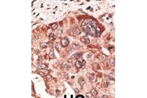 Formalin-fixed and paraffin-embedded human cancer tissue reacted with the primary antibody, which was peroxidase-conjugated to the secondary antibody, followed by DAB staining. (Recoverin Antikörper  (C-Term))