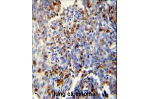 FOSL2 antibody immunohistochemistry analysis in formalin fixed and paraffin embedded human lung carcinoma followed by peroxidase conjugation of the secondary antibody and DAB staining.