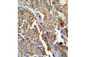 Immunohistochemical staining of formalin-fixed and paraffin-embedded human skin carcinoma reacted with ALDH3A2 monoclonal antibody  at 1:50-1:100 dilution.