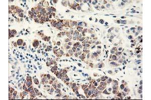 Immunohistochemical staining of paraffin-embedded Carcinoma of Human lung tissue using anti-EIF2B3 mouse monoclonal antibody. (EIF2B3 Antikörper)