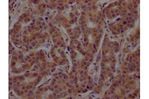IHC image of ABIN7148794 diluted at 1:200 and staining in paraffin-embedded human breast cancer performed on a Leica BondTM system. (ATF4 Antikörper  (AA 20-200))