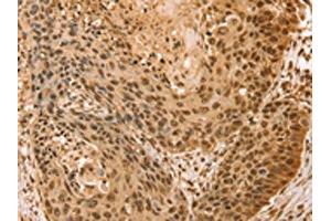 The image on the left is immunohistochemistry of paraffin-embedded Human esophagus cancer tissue using ABIN7131133(SNX8 Antibody) at dilution 1/25, on the right is treated with fusion protein. (SNX8 Antikörper)