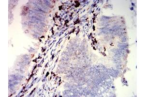 Immunohistochemical analysis of paraffin-embedded rectum cancer tissues using CD274 mouse mAb with DAB staining. (PD-L1 Antikörper  (AA 24-153))