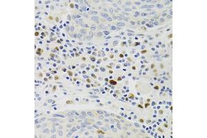 Immunohistochemistry of paraffin-embedded human lung cancer using GEMIN2 Antibody. (SIP1 Antikörper)