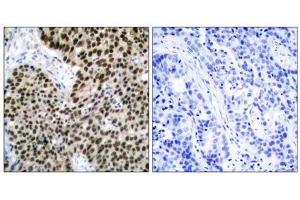 Immunohistochemical analysis of paraffin-embedded human breast carcinoma tissue using HSF1 (Ab-303) antibody (E021255). (HSF1 Antikörper)