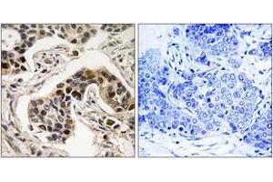 Immunohistochemistry analysis of paraffin-embedded human breast carcinoma, using NudC (Phospho-Ser326) Antibody. (NUDC Antikörper  (pSer326))