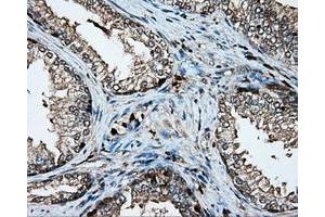 Immunohistochemical staining of paraffin-embedded Adenocarcinoma of colon tissue using anti-PLEK mouse monoclonal antibody. (Pleckstrin Antikörper)
