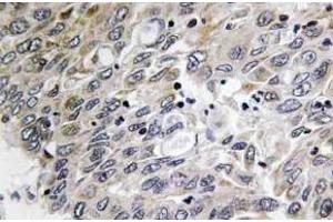Immunohistochemistry (IHC) analyzes of C1q-C antibody in paraffin-embedded human lung carcinoma tissue. (C1QC Antikörper)