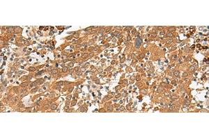 Immunohistochemistry of paraffin-embedded Human cervical cancer tissue using GFI1 Polyclonal Antibody at dilution of 1:100(x200) (GFI1 Antikörper)
