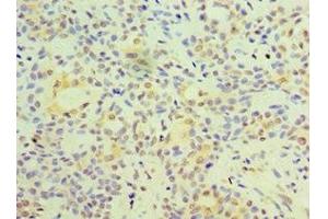 Immunohistochemistry of paraffin-embedded human breast cancer using ABIN7153128 at dilution of 1:100 (FOSL2 Antikörper  (AA 187-326))