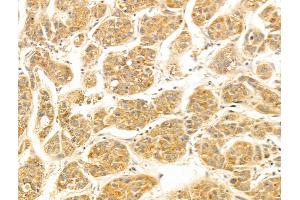 FUT6 Antibody at 1/100 staining Human liver cancer by IHC-P. (FUT6 Antikörper  (N-Term))